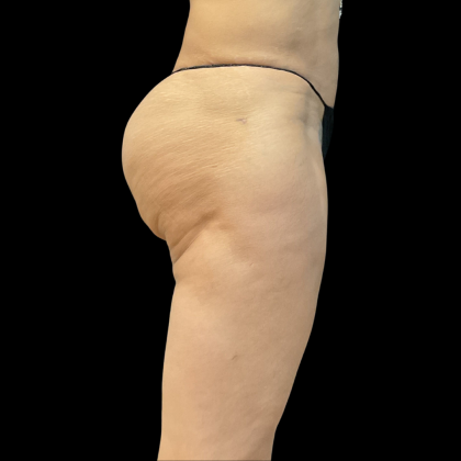 Fat Transfer Before & After Patient #13670