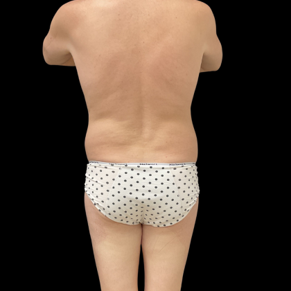 Rib Repositioning Before & After Patient #13675