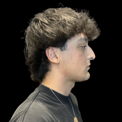 Liquid Rhinoplasty Before & After Patient #13676