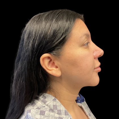 MyEllevate Before & After Patient #13624