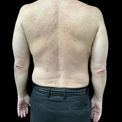Liposuction Before & After Patient #13685