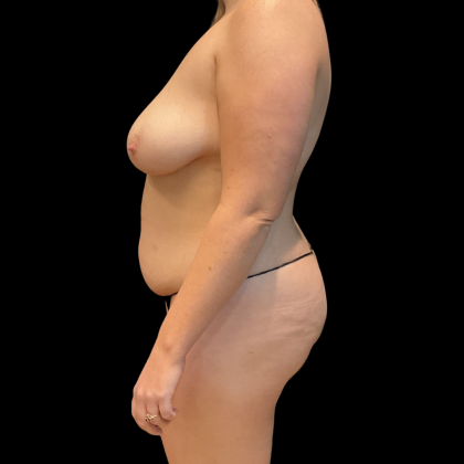 Tummy Tuck Before & After Patient #13686
