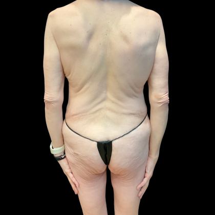 Tummy Tuck Before & After Patient #13682