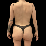 Brazilian Butt Lift Before & After Patient #14199