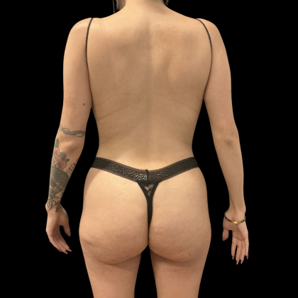 Brazilian Butt Lift Before & After Patient #14199