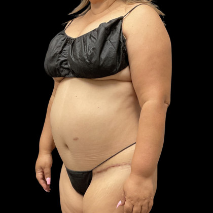 Brazilian Butt Lift Before & After Patient #13626