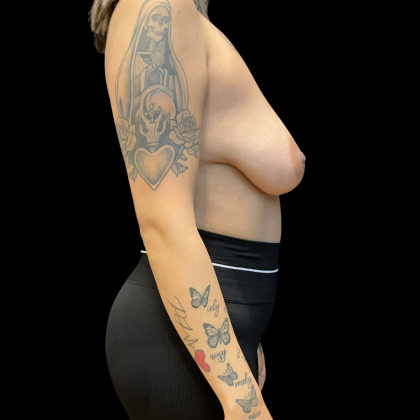 Mastopexy augmentation Before & After Patient #13657