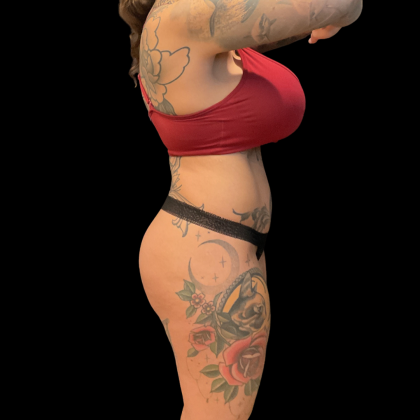 Butt Implants Before & After Patient #13659