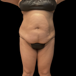Fat Transfer Before & After Patient #14378