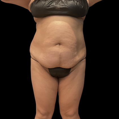 Fat Transfer Before & After Patient #14378