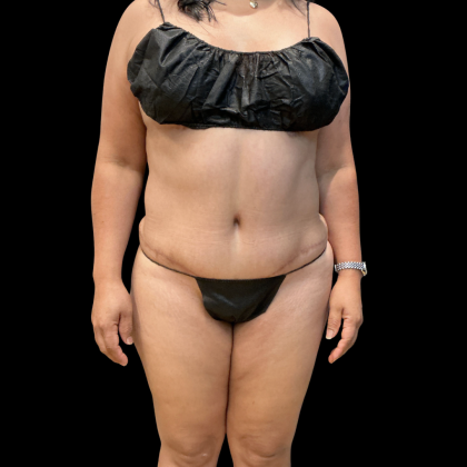 Liposuction Before & After Patient #14383