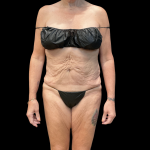 Fleur De Lis Tummy Tuck Before & After Patient #14384