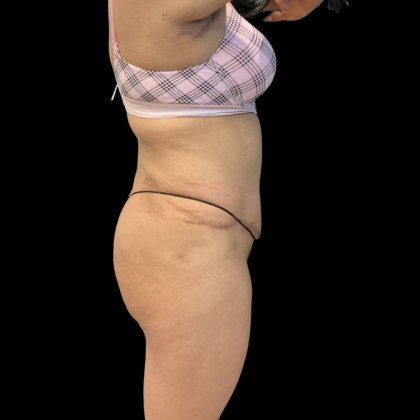 Fat Transfer Before & After Patient #14378