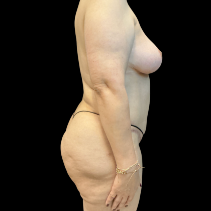 Mastopexy Before & After Patient #14379