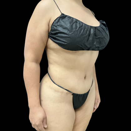 Liposuction Before & After Patient #14383