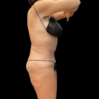 Fleur De Lis Tummy Tuck Before & After Patient #14384