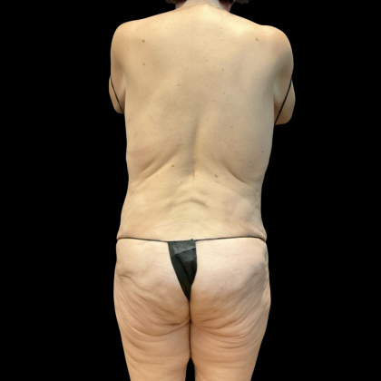 Fleur De Lis Tummy Tuck Before & After Patient #14384