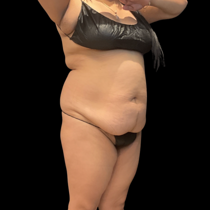 Fat Transfer Before & After Patient #14378