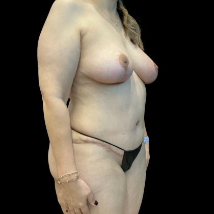 Mastopexy Before & After Patient #14379