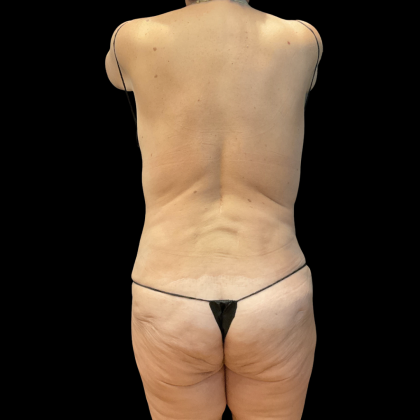 Fleur De Lis Tummy Tuck Before & After Patient #14384