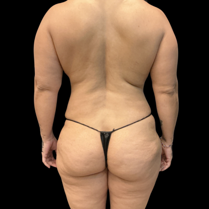 Tummy Tuck Before & After Patient #14387