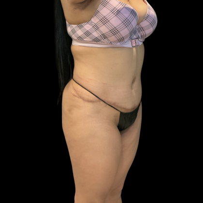 Fat Transfer Before & After Patient #14378