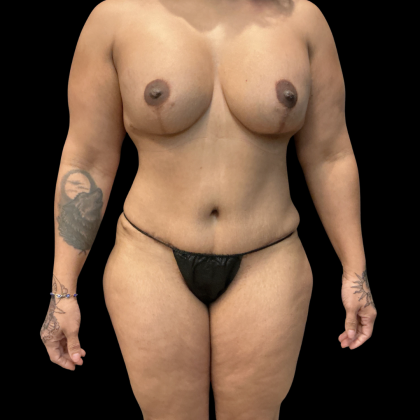 Tummy Tuck Before & After Patient #14387