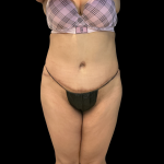 Fat Transfer Before & After Patient #14378