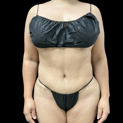 Liposuction Before & After Patient #14383
