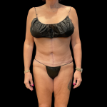 Fleur De Lis Tummy Tuck Before & After Patient #14384