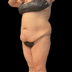 Fat Transfer Before & After Patient #14378