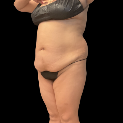 Fat Transfer Before & After Patient #14378