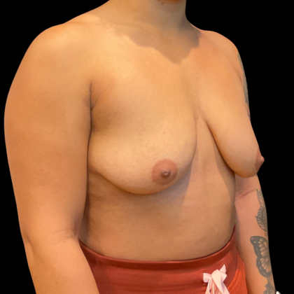 Breast Augmentation Before & After Patient #14382
