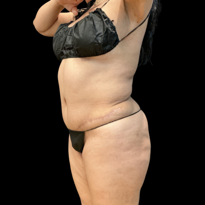 Liposuction Before & After Patient #14383