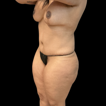 Tummy Tuck Before & After Patient #14387