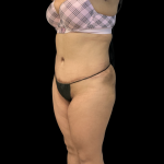 Fat Transfer Before & After Patient #14378