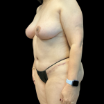 Mastopexy Before & After Patient #14379
