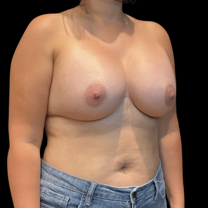 Breast Augmentation Before & After Patient #14381