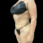 Liposuction Before & After Patient #14383
