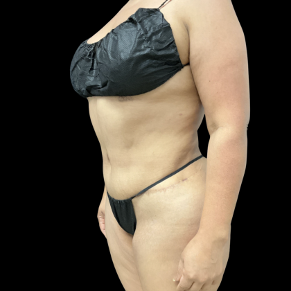 Liposuction Before & After Patient #14383