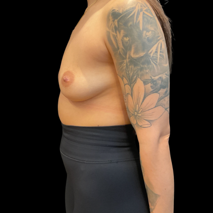 Breast Augmentation Before & After Patient #14376