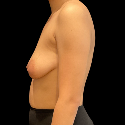 Mastopexy augmentation Before & After Patient #14386