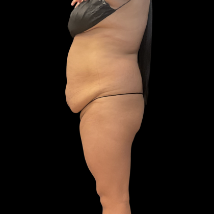Fat Transfer Before & After Patient #14378