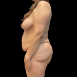 Mastopexy Before & After Patient #14379