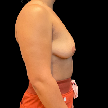 Breast Augmentation Before & After Patient #14382