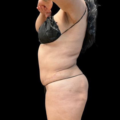 Liposuction Before & After Patient #14383