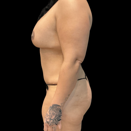 Tummy Tuck Before & After Patient #14387