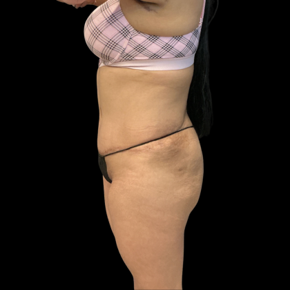 Fat Transfer Before & After Patient #14378