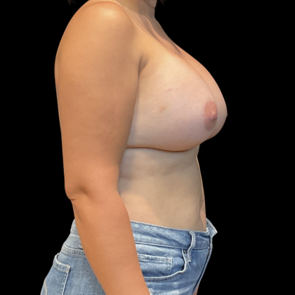 Breast Augmentation Before & After Patient #14381