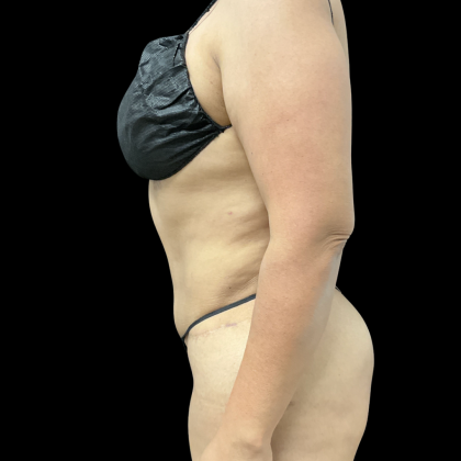 Liposuction Before & After Patient #14383